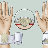 Applying a pressure bandage