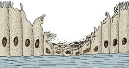 Biểu mô bị cắt của đường hô hấp của người hút thuốc