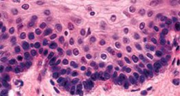 Squatous không keratinised phân tầng