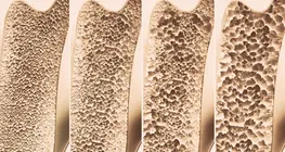 Osteoporosis